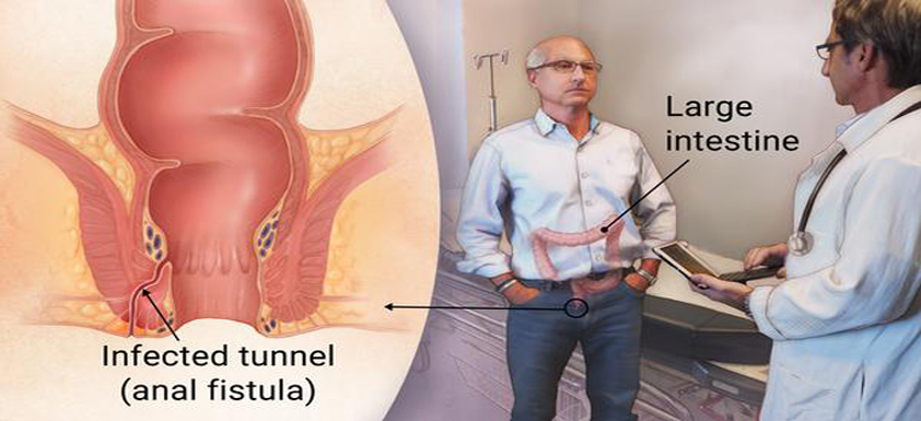 fistula in ano