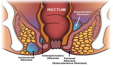 Fistula in Ano