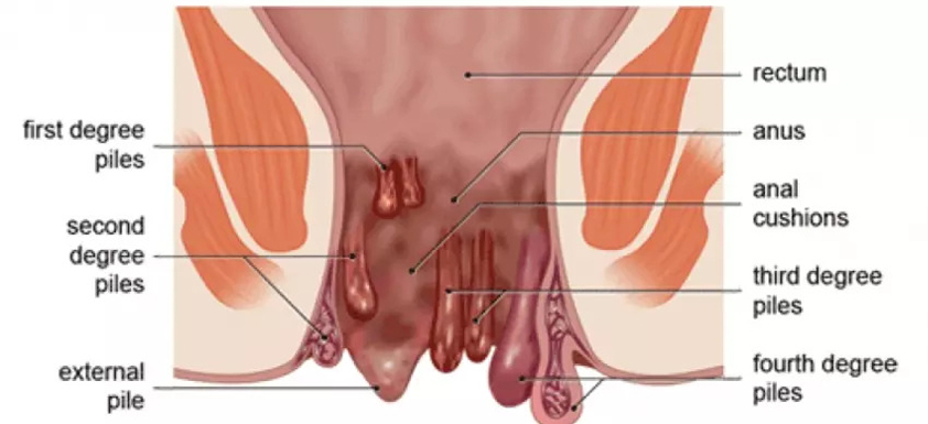 Piles/ Hemorrhoids