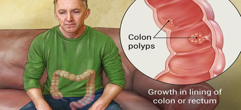 polyps-rectum